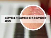 天津中医皮肤科治疗银屑病 天津治疗银屑病的医院