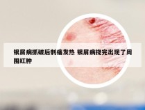 银屑病抓破后刺痛发热 银屑病挠完出现了周围红肿