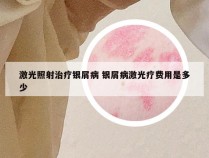 激光照射治疗银屑病 银屑病激光疗费用是多少