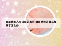 银屑病的人可以吃芒果吗 银屑病吃芒果又复发了怎么办