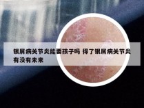 银屑病关节炎能要孩子吗 得了银屑病关节炎有没有未来