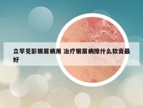 立竿见影银屑病用 冶疗银屑病擦什么软膏最好