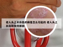 老人头上长白色的癣是怎么引起的 老人头上长白斑有何原因