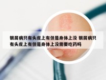 银屑病只有头皮上有但是身体上没 银屑病只有头皮上有但是身体上没需要吃药吗