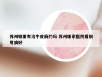 苏州哪里有治牛皮癣的吗 苏州哪家医院看银屑病好