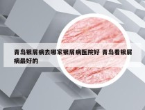 青岛银屑病去哪家银屑病医院好 青岛看银屑病最好的