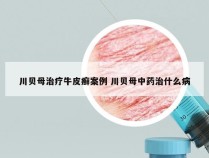 川贝母治疗牛皮癣案例 川贝母中药治什么病