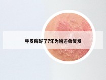 牛皮癣好了7年为啥还会复发