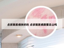 点状银屑病快好的 点状银屑病需要忌口吗