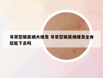 寻常型银屑病大爆发 寻常型银屑病爆发全身后能下去吗