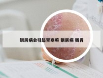 银屑病会引起胃寒嘛 银屑病 肠胃