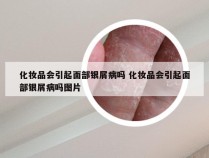 化妆品会引起面部银屑病吗 化妆品会引起面部银屑病吗图片
