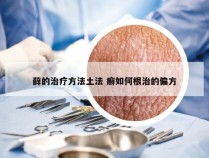 藓的治疗方法土法 癣如何根治的偏方