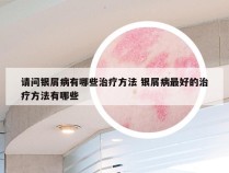 请问银屑病有哪些治疗方法 银屑病最好的治疗方法有哪些