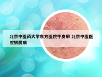 北京中医药大学东方医院牛皮癣 北京中医医院银屑病