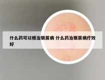 什么药可以根治银屑病 什么药治银屑病疗效好