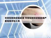 寻常型斑块状银屑病 寻常型斑块状银屑病严重程度评估工具