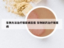 生物方法治疗银屑病百度 生物制药治疗银屑病