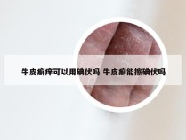 牛皮癣痒可以用碘伏吗 牛皮癣能擦碘伏吗