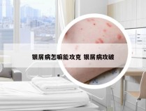 银屑病怎嘛能攻克 银屑病攻破