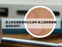 脸上有点银屑病可以化妆吗 脸上轻微银屑病能抹药膏吗?