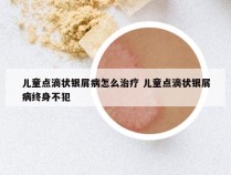 儿童点滴状银屑病怎么治疗 儿童点滴状银屑病终身不犯
