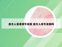 南方人容易得牛皮癣 南方人有牛皮癣吗