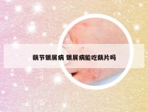 藕节银屑病 银屑病能吃藕片吗