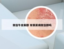 微信牛皮癣群 有银屑病微信群吗