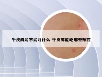 牛皮癣能不能吃什么 牛皮癣能吃那些东西