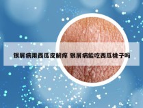 银屑病用西瓜皮解痒 银屑病能吃西瓜桃子吗