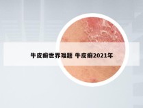 牛皮癣世界难题 牛皮癣2021年