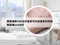 银屑病用UVB治疗最多可以持续多长时间 银屑病uvb光疗