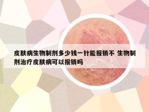 皮肤病生物制剂多少钱一针能报销不 生物制剂治疗皮肤病可以报销吗