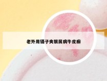 老外用镊子夹银屑病牛皮癣