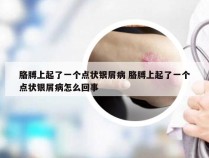 胳膊上起了一个点状银屑病 胳膊上起了一个点状银屑病怎么回事