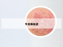 牛皮癣血滤