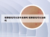 硫磺香皂可以洗牛皮癣吗 硫磺香皂可以治癣吗