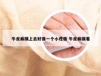 牛皮癣摸上去好像一个小疙瘩 牛皮癣摸着