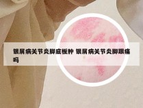 银屑病关节炎脚底板肿 银屑病关节炎脚跟痛吗