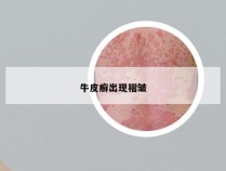 牛皮癣出现褶皱