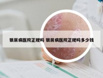 银屑病医院正规吗 银屑病医院正规吗多少钱