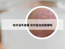 松针治牛皮癣 松针能治皮肤痒吗