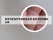 皮炎宁酊治疗牛皮癣怎么样 皮炎宁酊效果怎么样