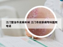江门整治牛皮癣长城 江门市皮肤病专科医院电话