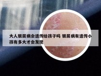 大人银屑病会遗传给孩子吗 银屑病有遗传小孩有多大才会发现