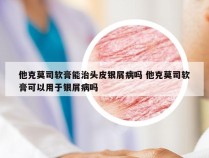 他克莫司软膏能治头皮银屑病吗 他克莫司软膏可以用于银屑病吗
