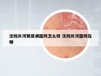 沈阳长河银屑病医院怎么样 沈阳长河医院在哪