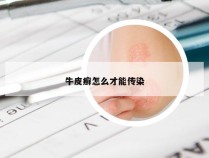 牛皮癣怎么才能传染