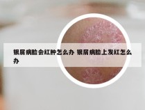 银屑病脸会红肿怎么办 银屑病脸上发红怎么办